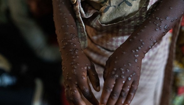 Monkeypox Evolution Reaches Deadly Strain, Now Detected in US