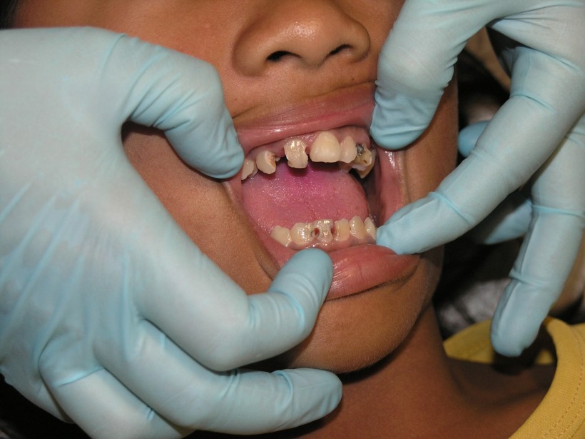 Psychological Impact of Bad Teeth