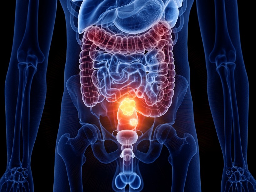 3d rendered medically accurate illustration of colon cancer