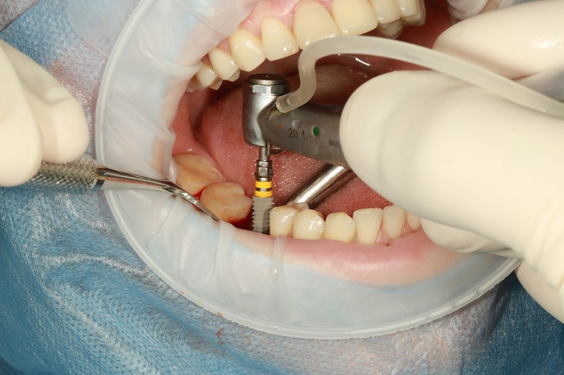 Five of the Most Common Types of Dental Surgery