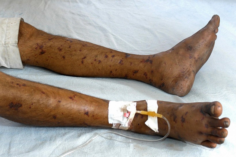 Indian patient with the symptoms of bacterial meningitis