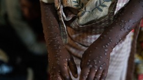 Monkeypox Evolution Reaches Deadly Strain, Now Detected in US